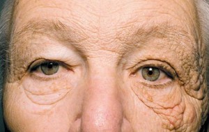 Nhược cơ là bệnh gì?