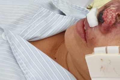 Hàng chục người nhập viện Bạch Mai do nhiễm vi khuẩn ăn thịt người