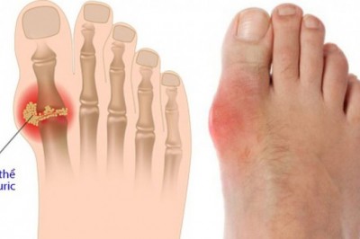 Đàn ông bị bệnh gút nên ăn gì?