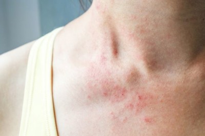Nguyên nhân và cách điều trị viêm da dị ứng