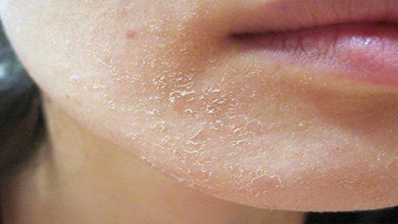 Mách nhỏ: Nếu có làn da khô, sần sùi, nứt nẻ, những loại thực phẩm dưới đây