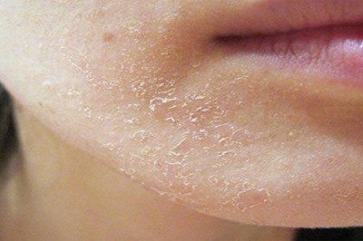 Mách nhỏ: Nếu có làn da khô, sần sùi, nứt nẻ, những loại thực phẩm dưới đây