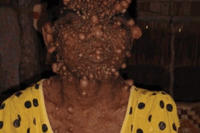 Những cơ thể biến dạng vì u sợi thần kinh