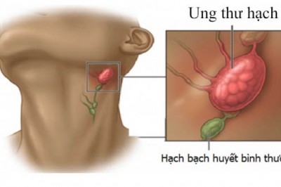 Những lưu ý về ung thư hạch bạch huyết