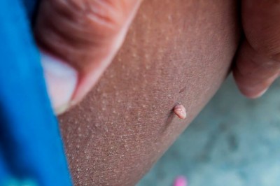 Mụn thịt trên da có nguy hiểm không, loại bỏ thế nào?