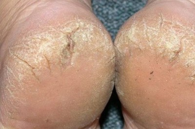 Những nguyên nhân gây ra bệnh nứt nẻ gót chân ít người biết