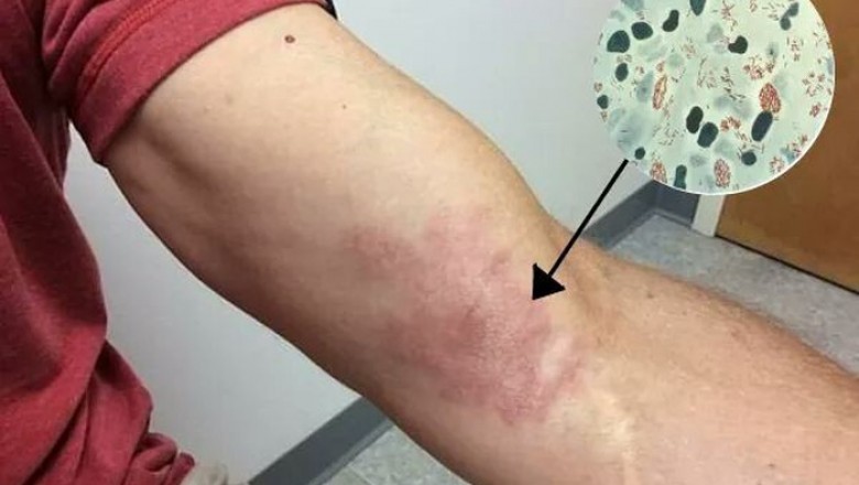 Bệnh phong có lây không?