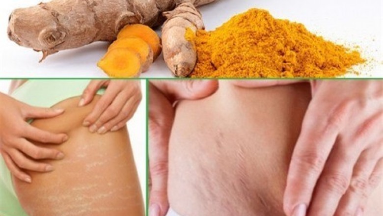 Mách mẹ bỉm sữa 3 cách chữa rạn da sau sinh bằng nghệ cực hiệu quả