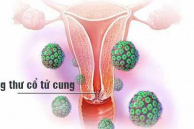 Những điều cần biết về Bệnh ung thư cổ tử cung