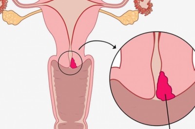 Ung thư cổ tử cung, Nguyên nhân, dấu hiệu, triệu chứng, giai đoạn, điều trị và phòng bệnh thế nào?