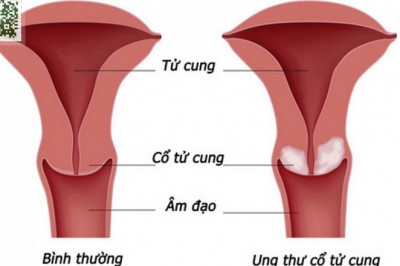 7 dấu hiệu ung thư cổ tử cung nguy hiểm, chị em nhất định không được bỏ qua