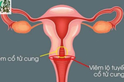 Bệnh viêm lộ tuyến cổ tử cung: 4 dấu hiệu nhận biết bệnh viêm lộ tuyến cổ tử cung