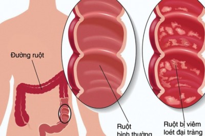 Viêm đại tràng, Nguyên nhân, Triệu chứng, Phòng và Điều trị bệnh Viêm Đại Tràng Mạn Tính