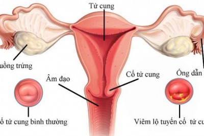 Nhiều phụ nữ bị viêm lộ tuyến cổ tử cung mà không biết