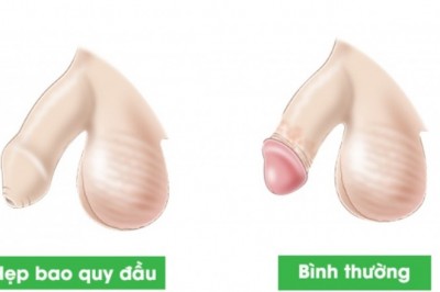 Bôi thuốc gì giúp trẻ nong bao quy đầu?