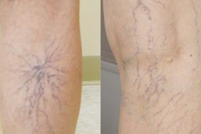 70% nữ giới bị suy giãn tĩnh mạch chân: Chuyên gia Bệnh viện Việt Đức khuyến cáo gì?