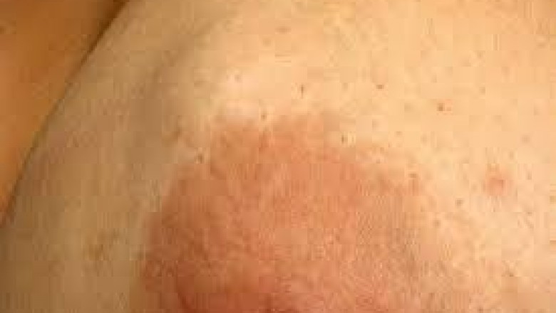 Nhận biết và phân biệt u vú lành tính và bệnh ung thư vú