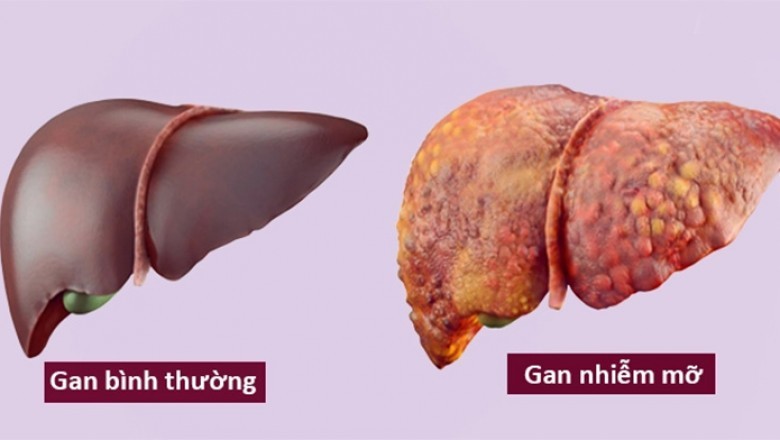 Gan nhiễm mỡ có nguy hiểm?