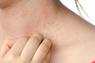 Ngứa khi trời lạnh, vì sao?