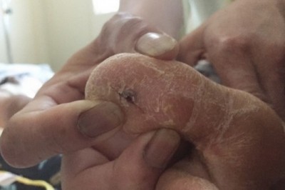 Dấu hiệu nhận biết bệnh uốn ván