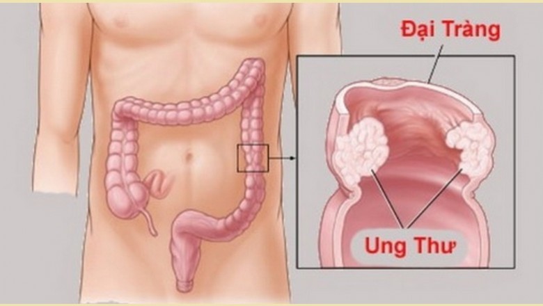 Thực phẩm phục hồi sức khỏe bệnh nhân ung thư đại tràng