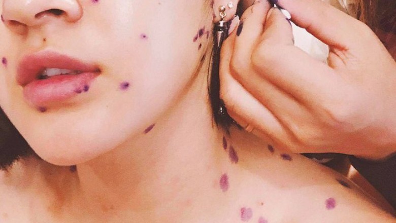 Bệnh thủy đậu ở người lớn và những biến chứng nguy hiểm khó lường