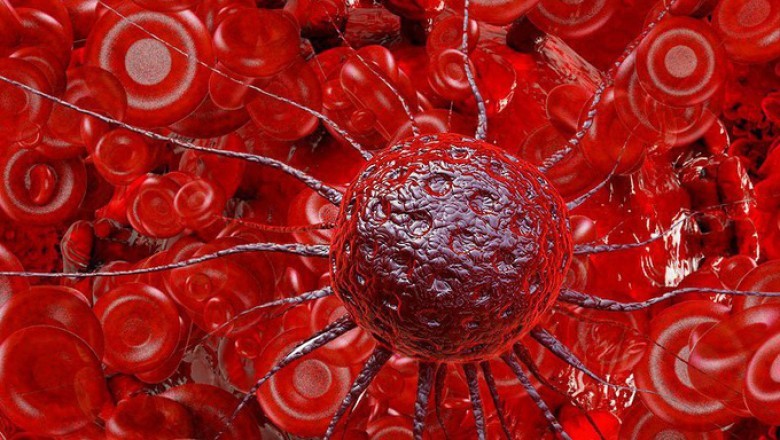 Những bệnh ung thư thường gặp nhất