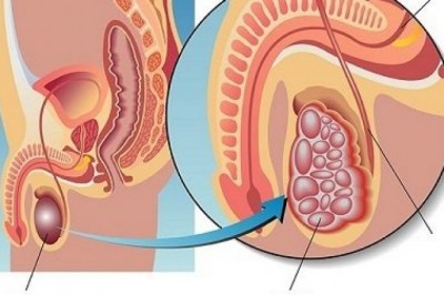 Ung thư tinh hoàn di căn gan