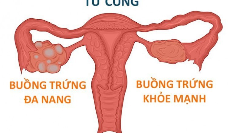 Dấu hiệu buồng trứng đa nang