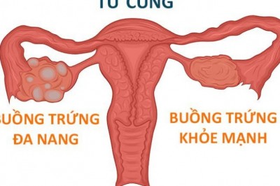 Dấu hiệu buồng trứng đa nang