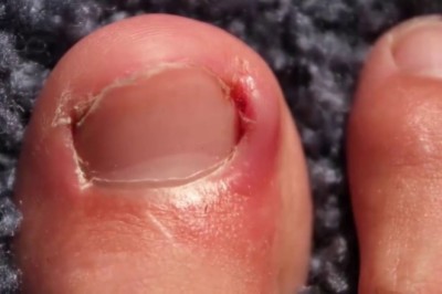 Bệnh chín mé gây biến chứng gì?