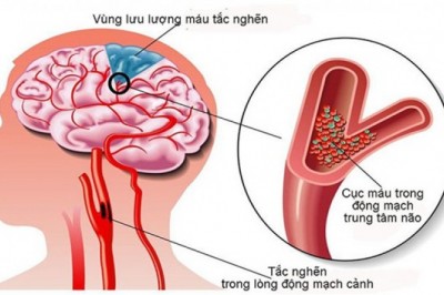 Sự thật về hoạt huyết dưỡng não tăng cường trí nhớ