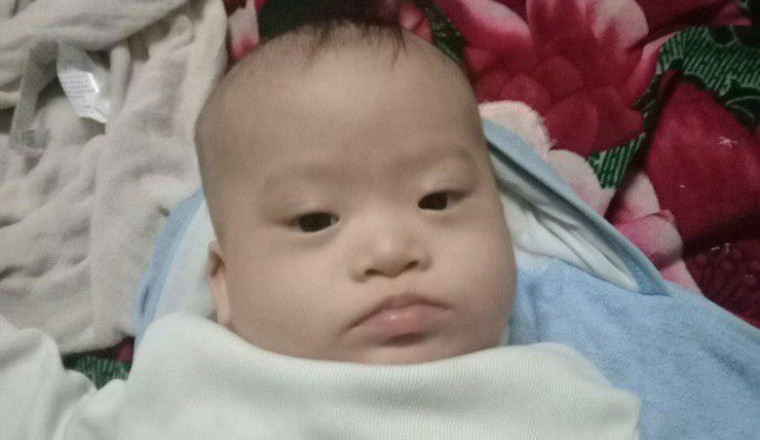 Hỏi đáp bệnh Down: Bé mắc hội chứng Down, có phòng được không?