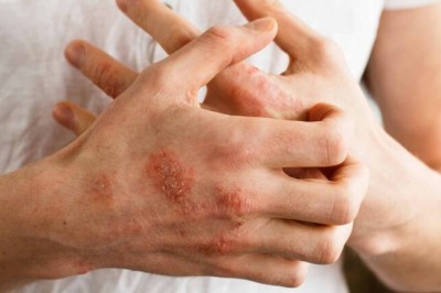 Bài thuốc nam chữa bệnh viêm da cơ địa, ngứa ngáy ngoài da