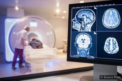 Thêm phát hiện cho thấy COVID-19 gây tổn thương não bộ