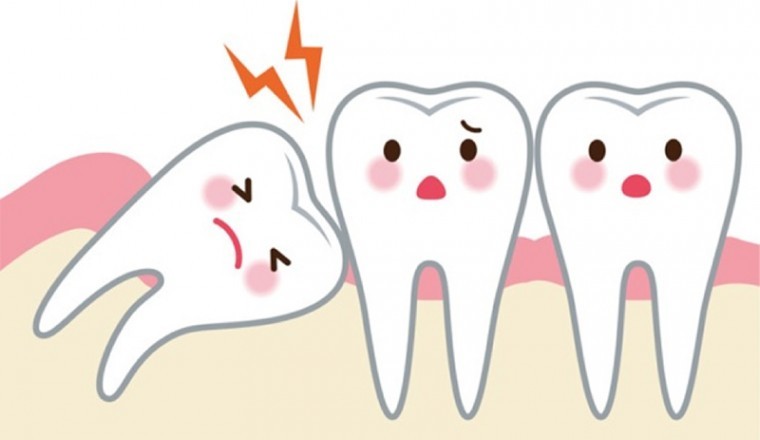 Mẹo giảm đau khi mọc răng khôn hiệu quả nhất ngay tại nhà