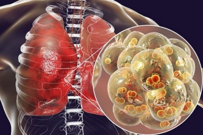 SARS-CoV-2 tấn công phổi như thế nào?