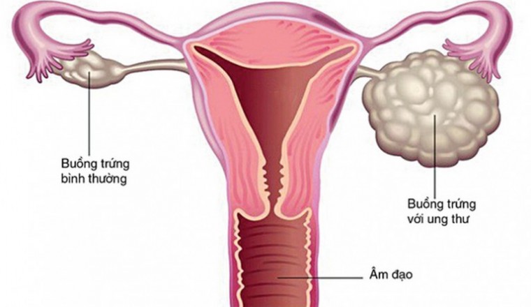 Thuốc ức chế một loại enzym, hứa hẹn trong điều trị ung thư buồng trứng