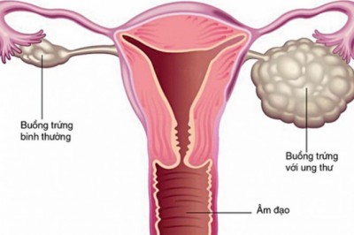 Thuốc ức chế một loại enzym, hứa hẹn trong điều trị ung thư buồng trứng