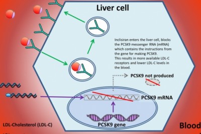Một mũi tiêm RNA có giá hơn 60 triệu, giúp hạ mỡ máu, phòng ngừa đột quỵ vừa được cơ quan y tế Anh chấp thuận