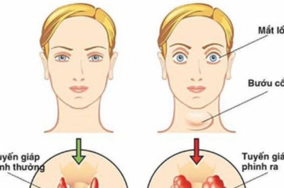 Bệnh Basedow, Cường giáp các phương pháp và thuốc chữa trị