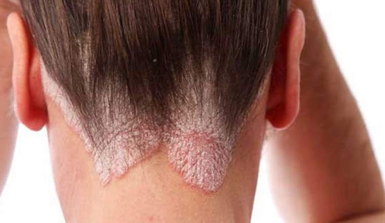 Tìm hiểu chi tiết về Bệnh Vảy Nến