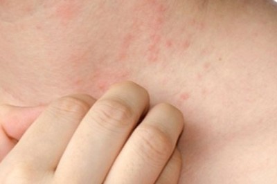 Cách chữa bị di chứng người mẩn ngứa hậu covid