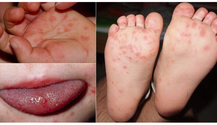 Đông y chữa bệnh chân tay miệng
