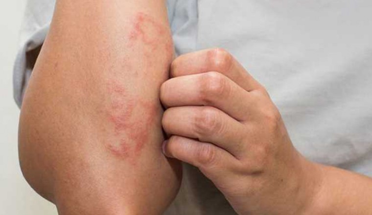 Những dấu hiệu nhận biết Bệnh Thận trên da bằng mắt thường