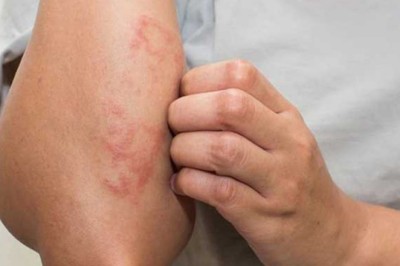 Những dấu hiệu nhận biết Bệnh Thận trên da bằng mắt thường