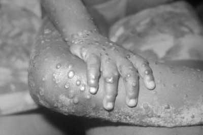 Bùng nổ các ca mắc đậu mùa khỉ trên toàn thế giới, WHO triệu tập họp khẩn