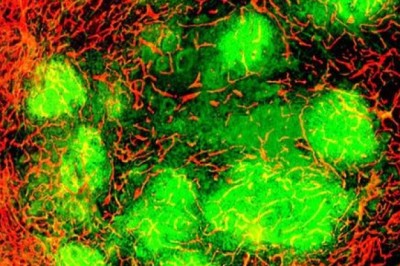 Tiêm virus diệt tế bào ung thư vào thẳng khối u