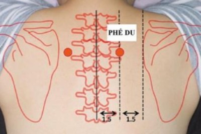 Người mắc bệnh viêm họng mạn tính có thể dùng sáu huyệt vị này để hỗ trợ phòng và trị viêm họng mạn tính