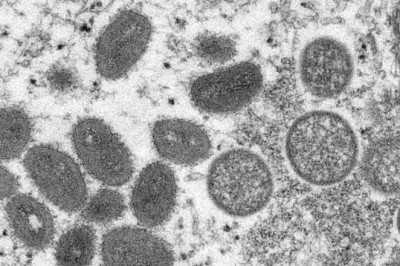 Bệnh đậu mùa khỉ bùng phát ở Mỹ 19 năm trước